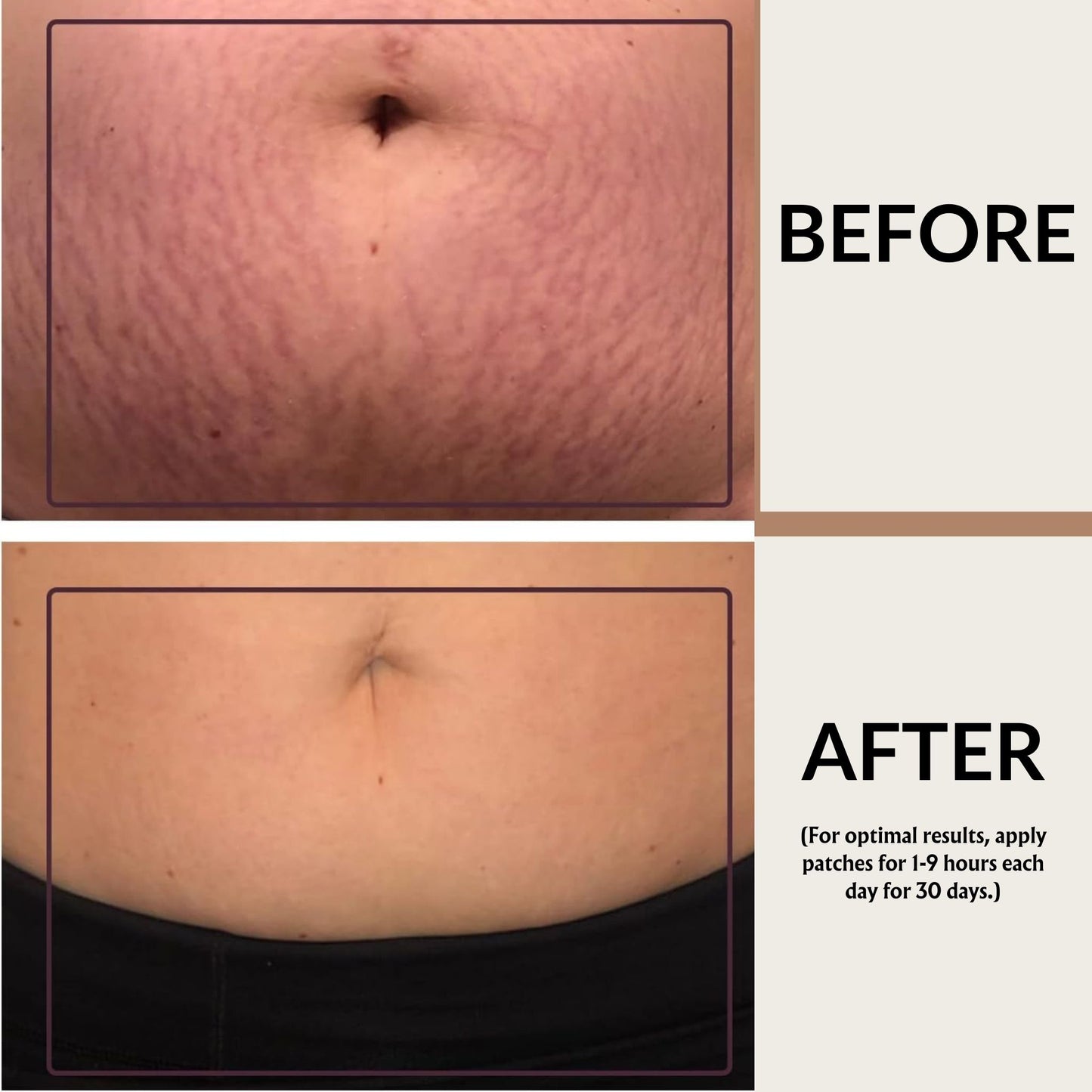 Magic Secret Silicone Anti Stretch Mark Stomach Patches