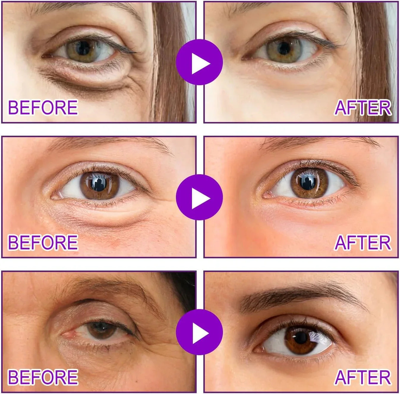 Microneedling Eye Patches